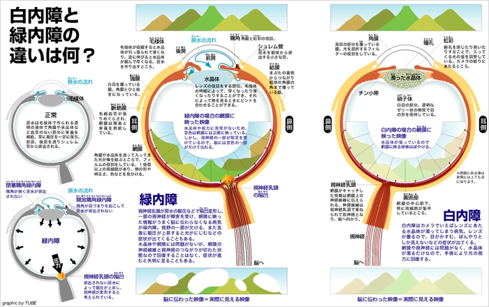 集英社 健康百科「白内障・緑内障」