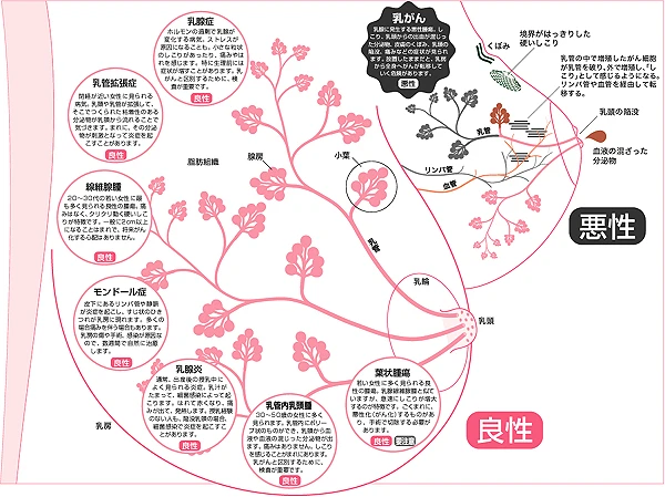 集英社 健康百科「乳がん」